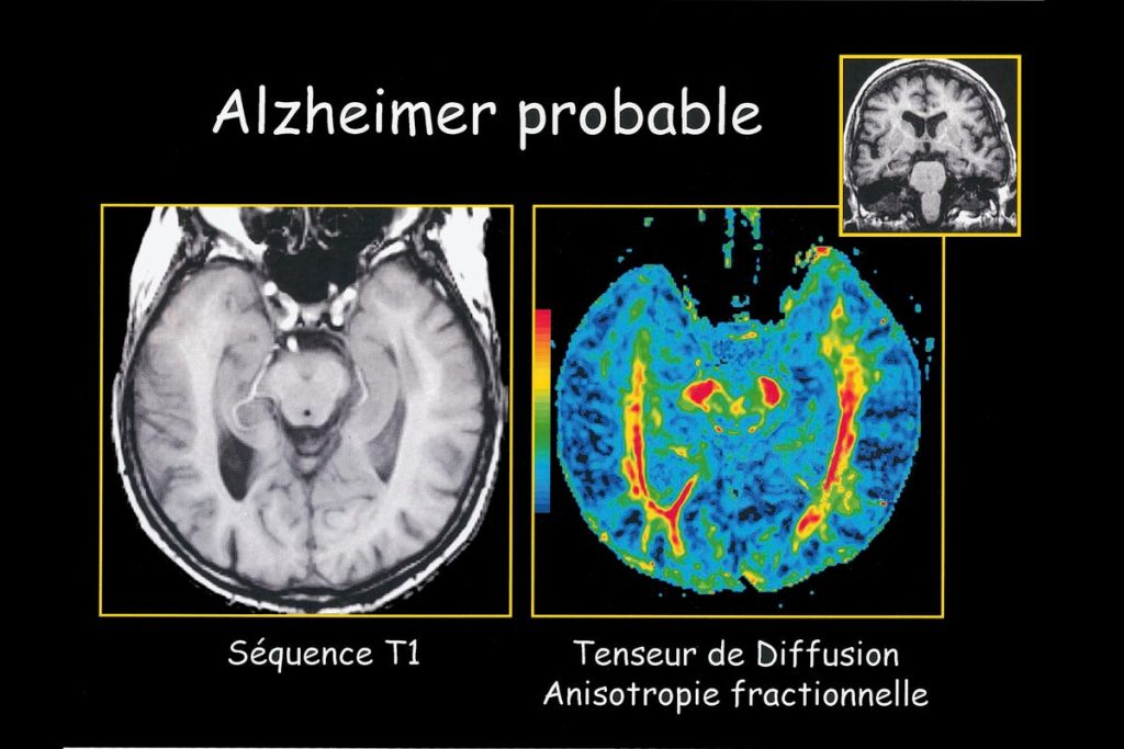 Alzheimer’s Disease, And The Myths Of Medications
